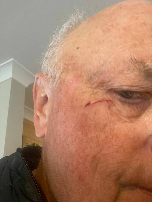 Graeme Hewett was cut just below the eye by a magpie near PCYC. Picture supplied